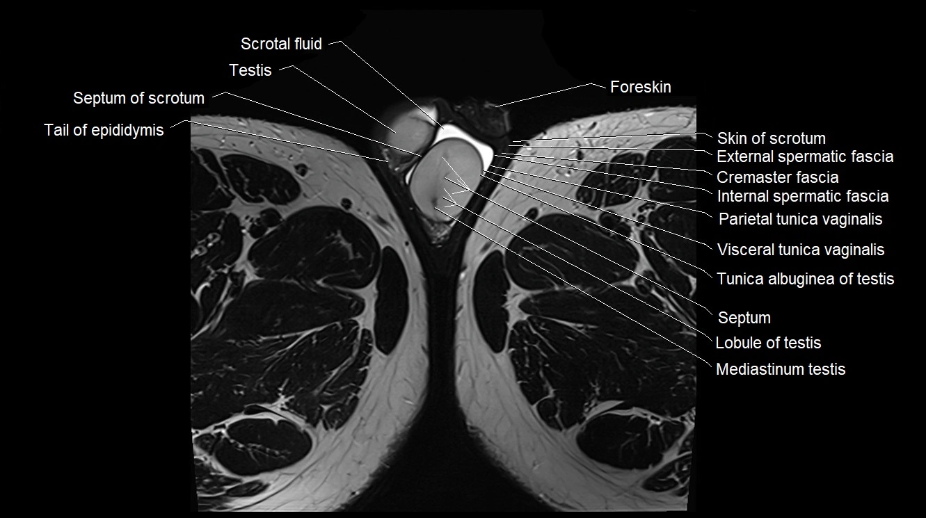 MRI 3T scrotum and penis axial cross sectional anatomy image 37.webp